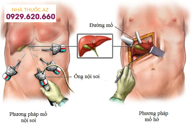 Cắt bỏ túi mật có ảnh hưởng gì đến sức khoẻ không?