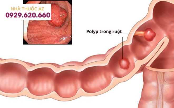 cat-polyp-ong-tieu-hoa-1
