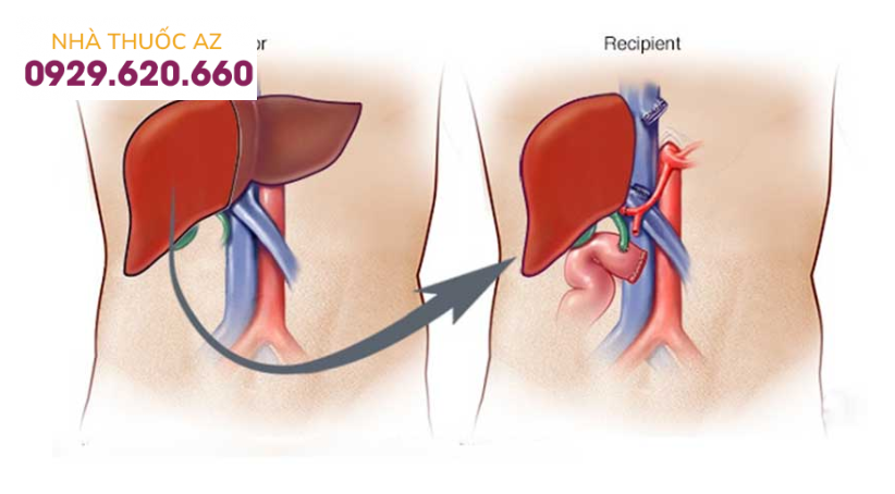 Phẫu thuật cấy ghép gan