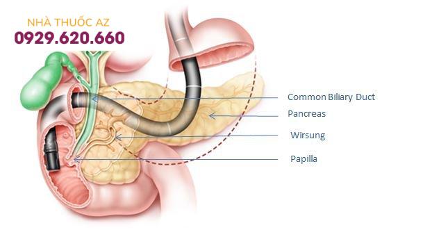 ERCP nội soi sỏi mật