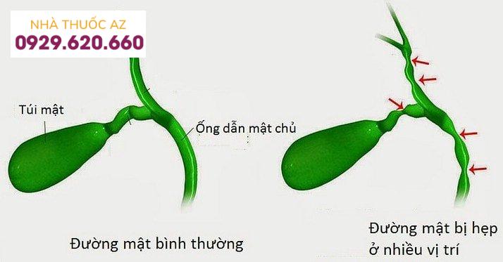 Chít hẹp đường mật