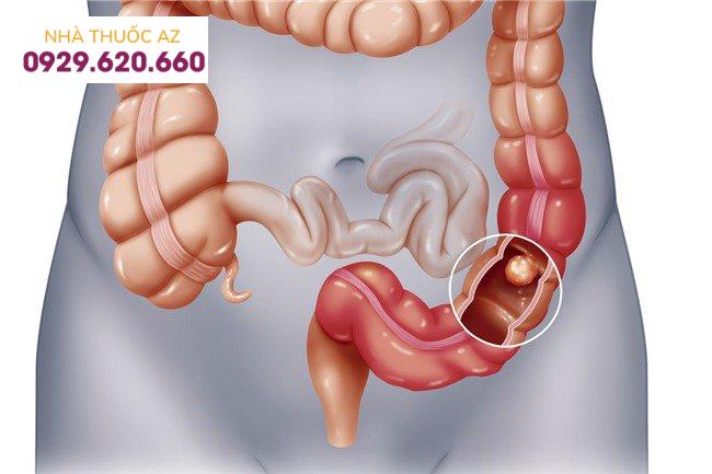 Phẫu thuật nội soi ung thư đại tràng