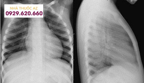 Thế nào là chụp X-quang tim phổi thẳng?