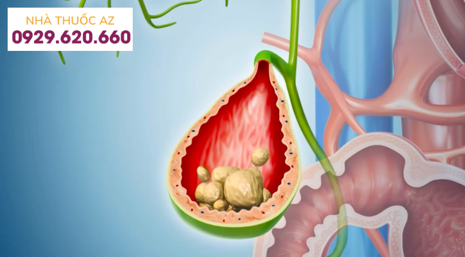 Sỏi bùn túi mật