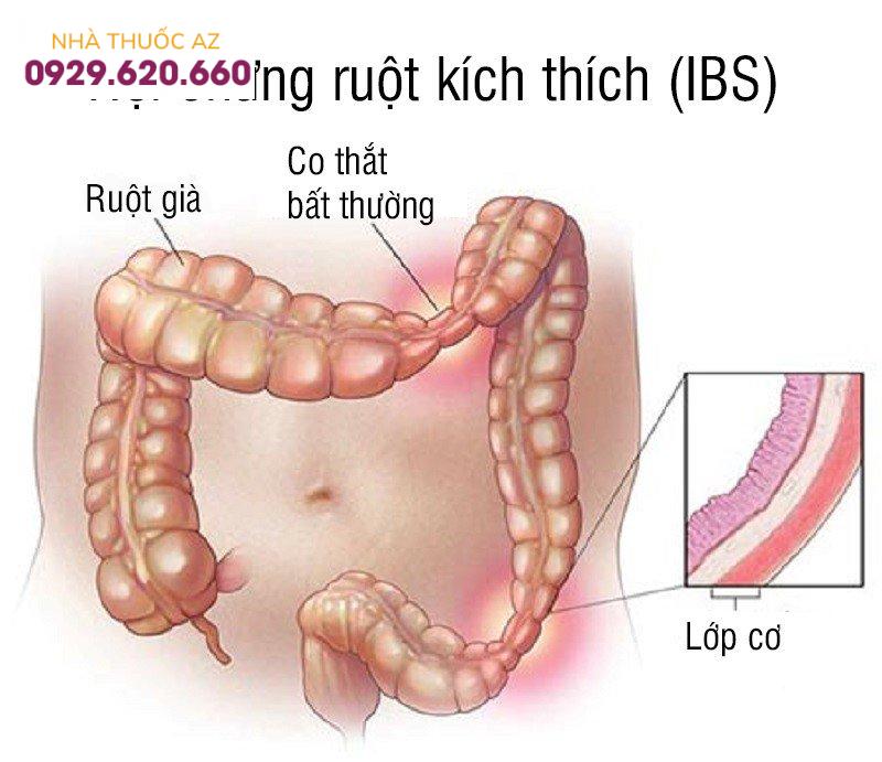 Hội chứng ruột kích thích