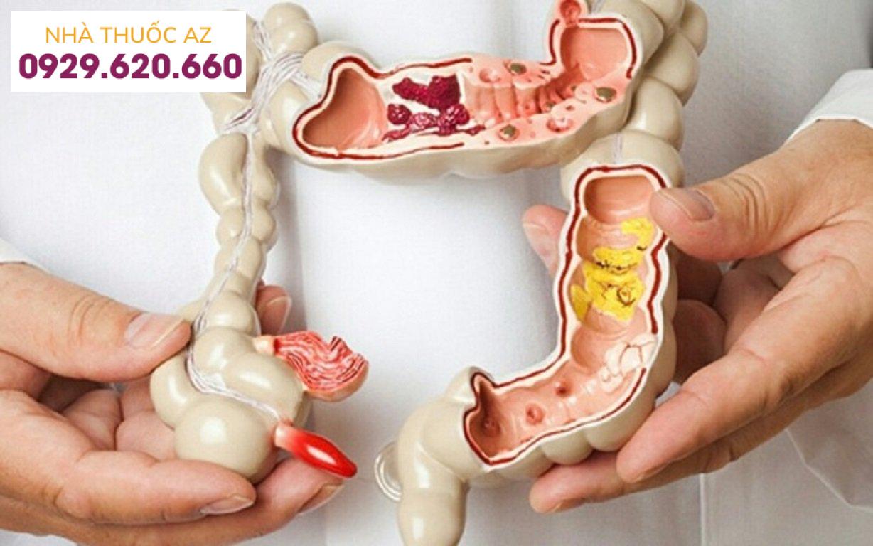 Điều trị polyp đại tràng