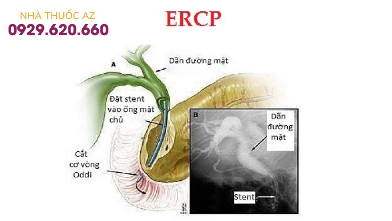 Nội soi mật tụy ngược dòng