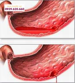 Thủng hành tá tràng