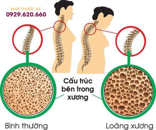 Điều trị loãng xương ở phụ nữ mãn kinh