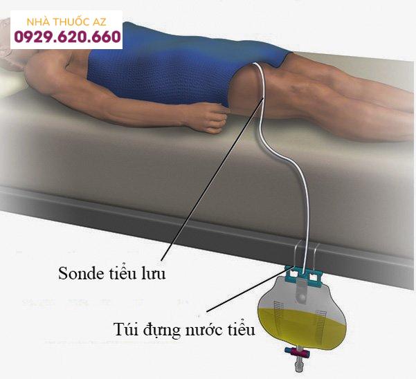 Đặt sonde tiểu lưu