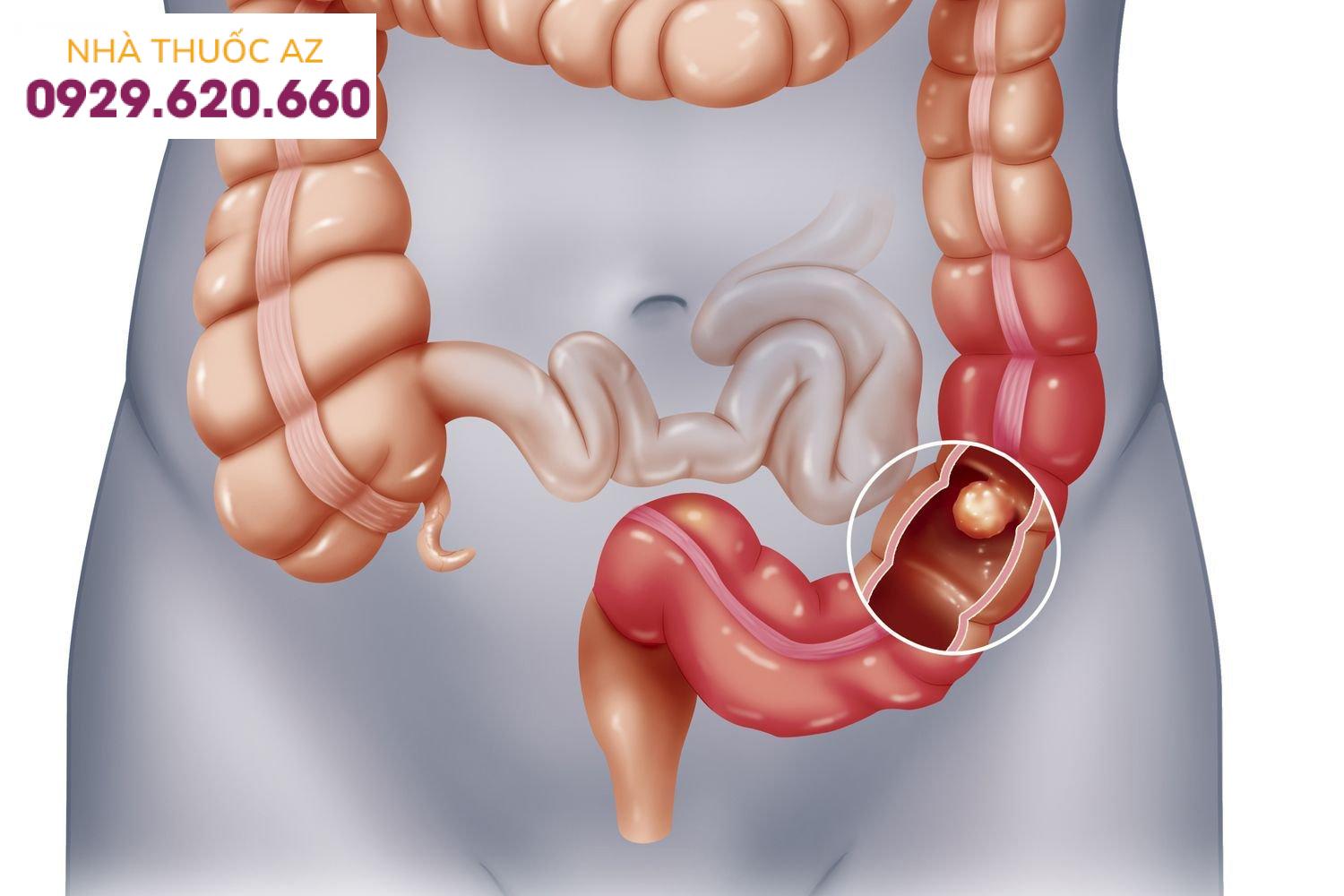 Phân biệt tắc ruột và liệt ruột sau mổ nhờ chụp CT