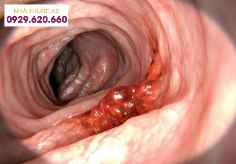 Ung thư đại trực tràng 2