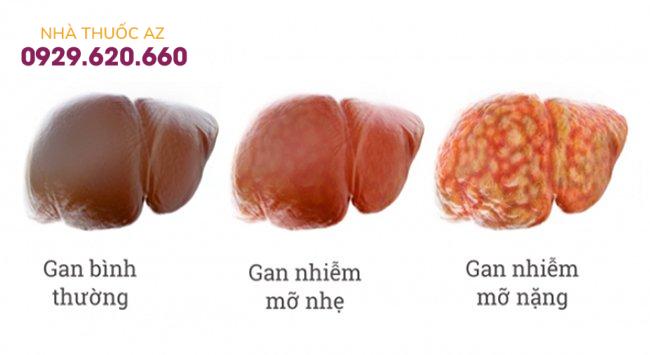 Có 3 cấp độ của bệnh gan nhiễm mỡ