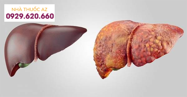 bệnh lý về gan
