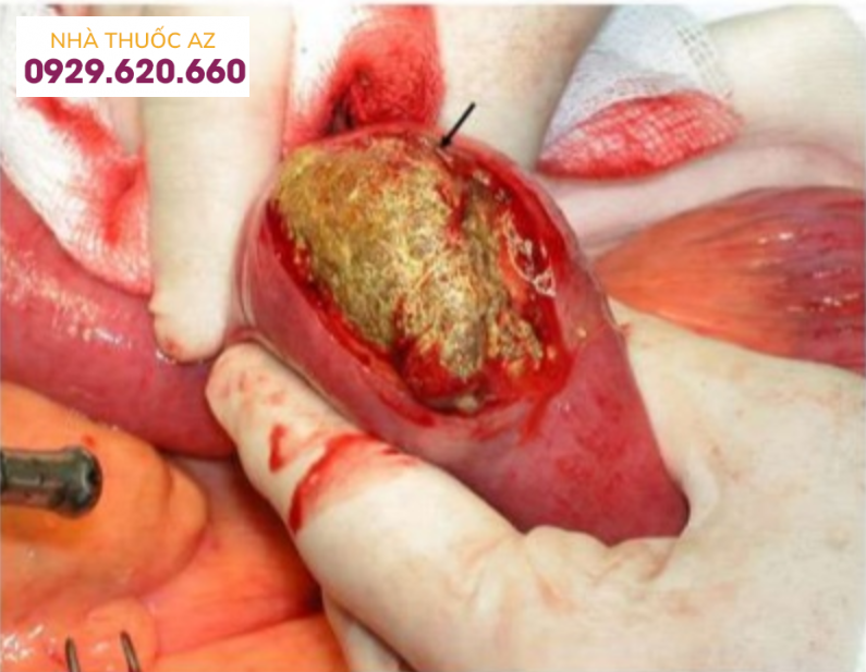 Tắc ruột do bít tắc