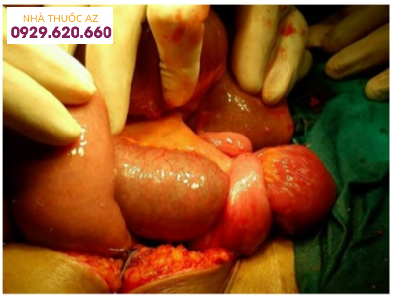 Tắc ruột do thắt nghẹt