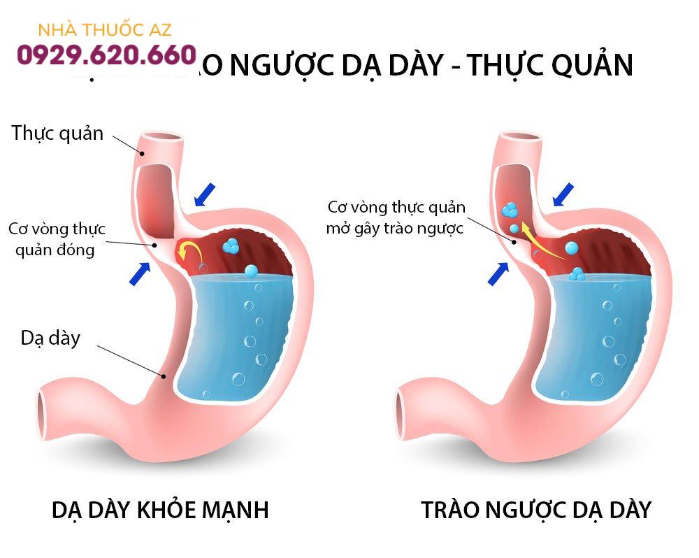 Trào ngược dạ dày thực quản