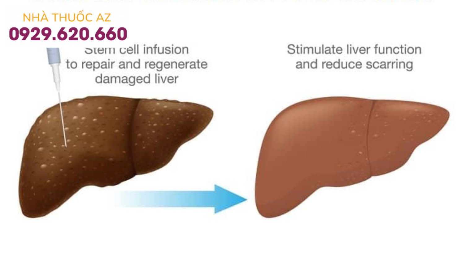 Ghép tế bào gốc cho bệnh nhân bị xơ gan