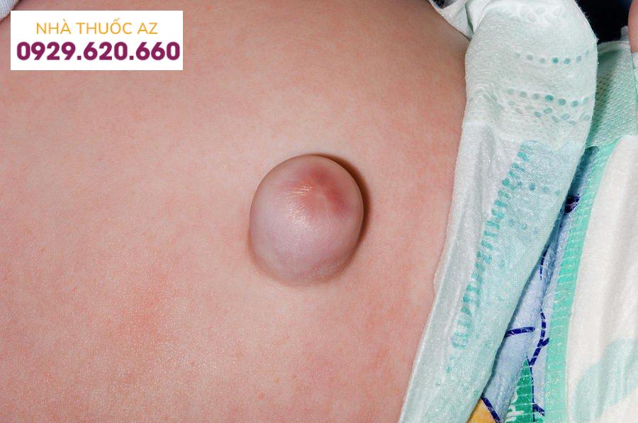 Hình ảnh trẻ bị thoát vị rốn