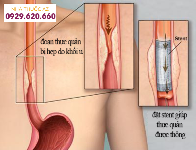 Kỹ thuật nội soi can thiệp đặt stent thực quản