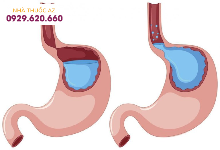 Làm thế nào để phân biệt ho do viêm phổi và do trào ngược dạ dày - thực quản?