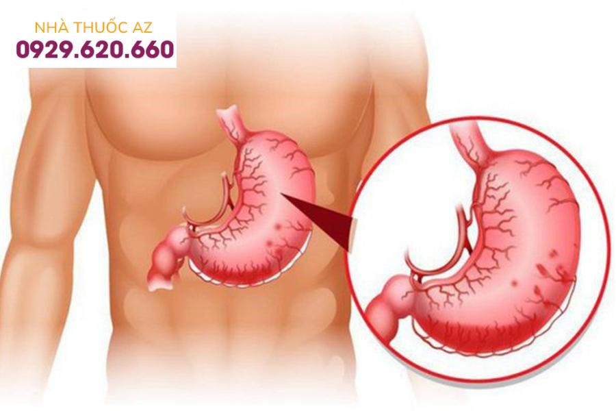 xuất huyết tiêu hóa