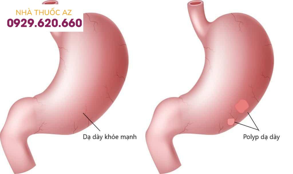 Polyp dạ dày