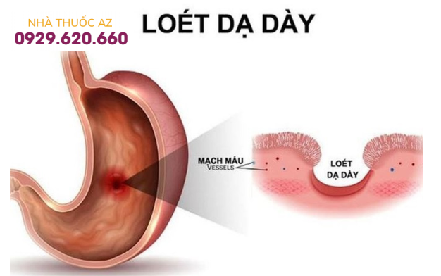 Viêm loét dạ dày