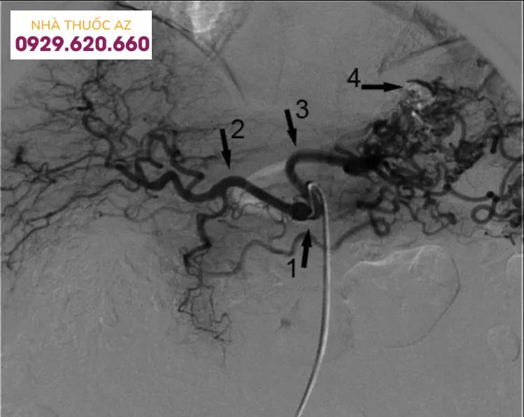 Giãn tĩnh mạch dạ dày do huyết khối động mạch lách
