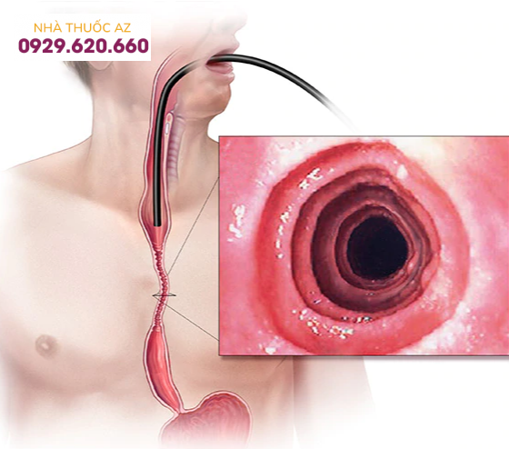 viêm thực quản bạch cầu ái toan