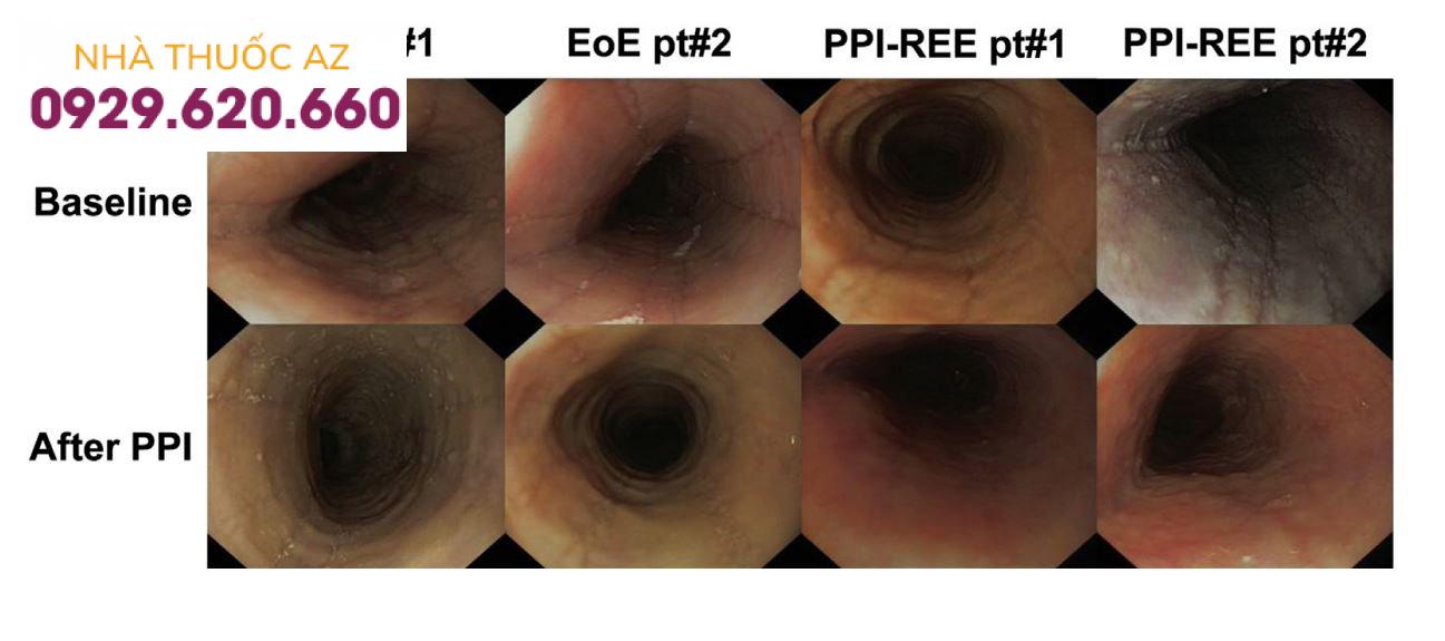 Kết quả nội soi lâm sàng của PPI-REE