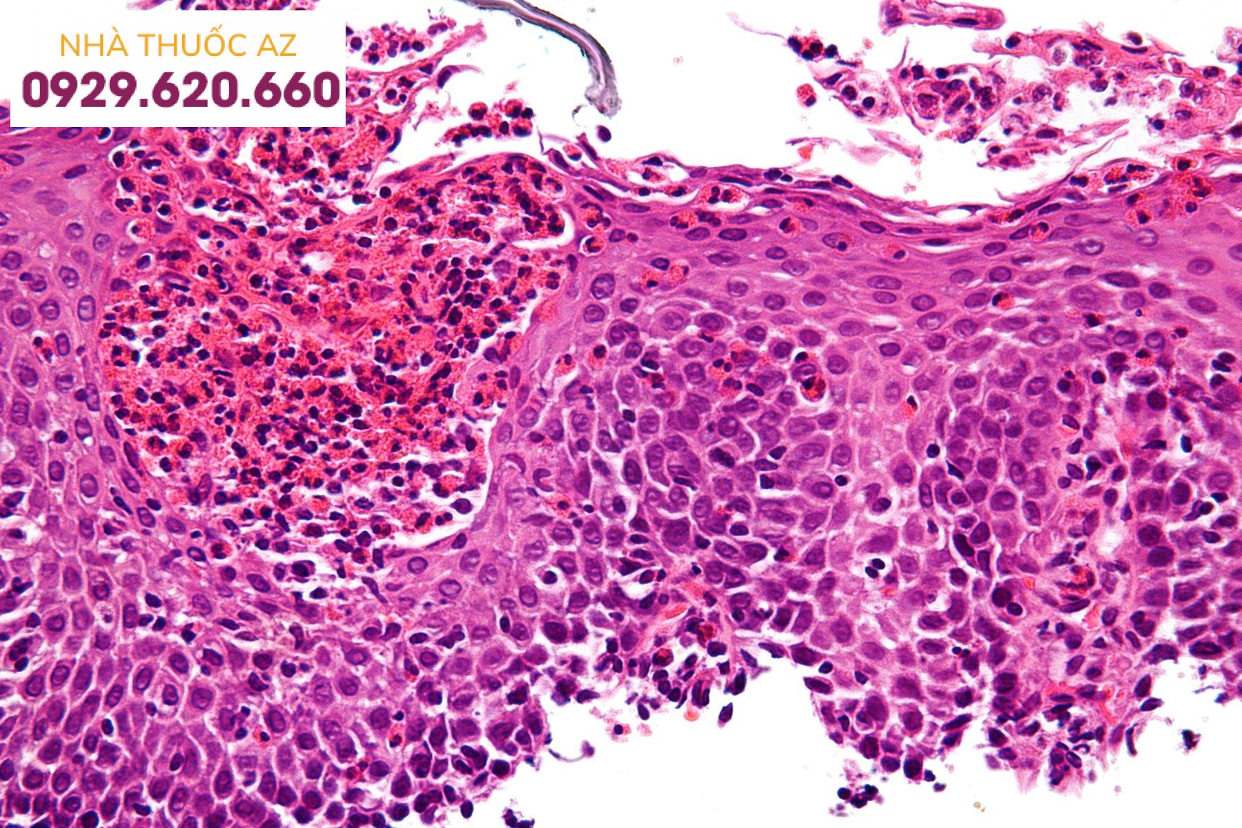 Hình ảnh hiển vi cho thấy viêm thực quản tăng bạch cầu ái toan.