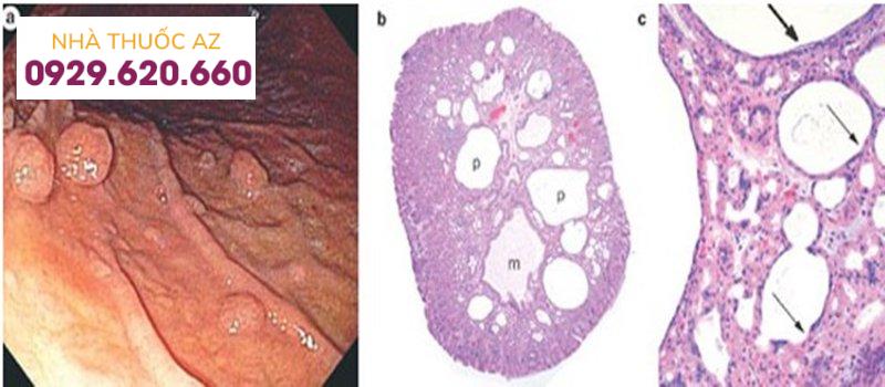 polyp tuyến đáy vị