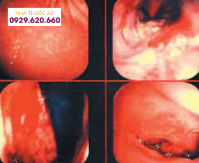 Hình ảnh nội soi của viêm dạ dày do bạch cầu ái toan