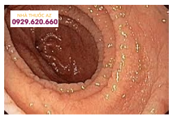 Hình ảnh nội soi bệnh nhân được chẩn đoán bệnh Celiac