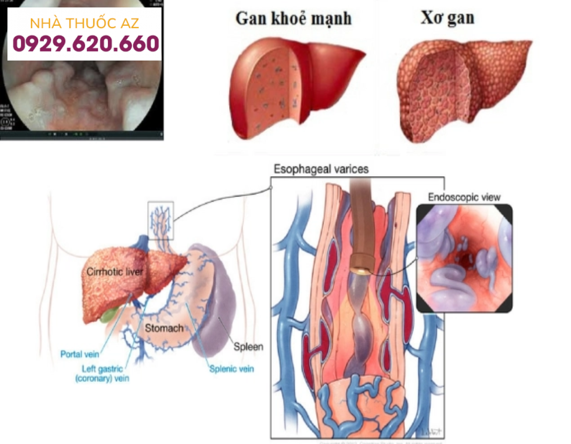 Tăng áp lực trong long hệ tĩnh mạch cửa