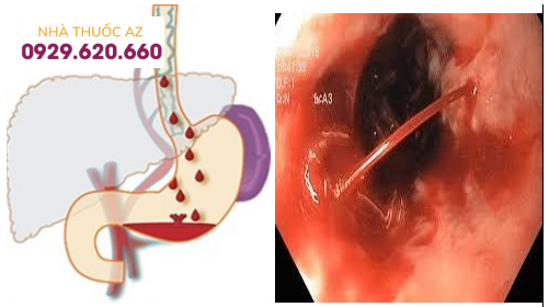 Xuất huyết tiêu hóa do vỡ dãn tĩnh mạch thực quản – hậu quả của giãn tĩnh mạch thực quản không được điều trị