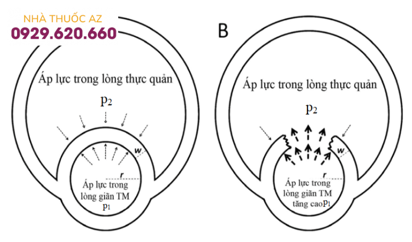 Cơ chế vỡ giãn tĩnh mạch thực quản.