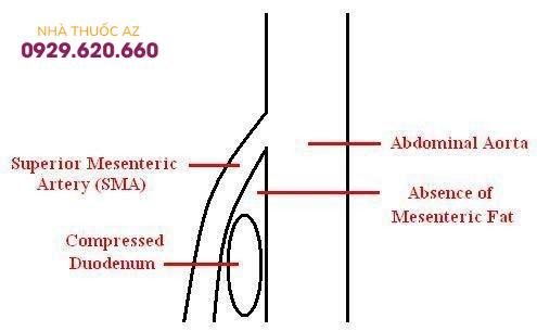 Tá tràng bị đè nén do góc giữa động mạch chủ bụng và động mạch mạc treo tràng trên giảm.