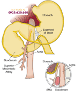 Tá tràng bị đè nén do góc giữa động mạch chủ bụng và động mạch mạc treo tràng trên giảm