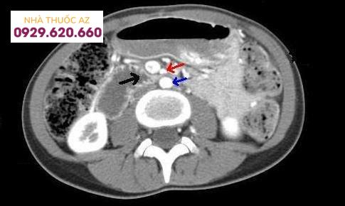 CT bụng và vùng chậu cho thấy: tá tràng bị chèn ép (mũi tên đen) giữa động mạch mạc treo tràng trên (mũi tên màu đỏ) và động mạch chủ bụng (mũi tên màu xanh).