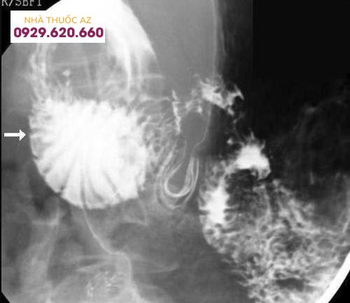 Tá tràng bị giãn rộng (mũi tên), bị thắt đột ngột bởi động mạch mạc treo tràng trên.