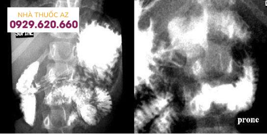 X quang uống thuốc cản quang