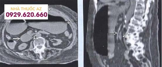 Hội chứng ĐM TTT ở do bị vẹo cột sống ra trước gây hẹp góc.