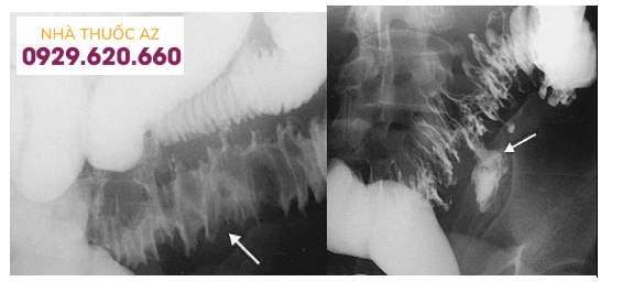 Chụp đại tràng cản quang