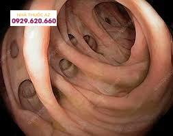 Hình ảnh nội soi cho thấy có nhiều túi thừa ở đại tràng