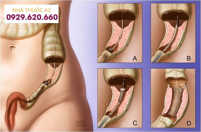 Stent đại tràng được sử dụng để giải áp chỗ hẹp của đại tràng