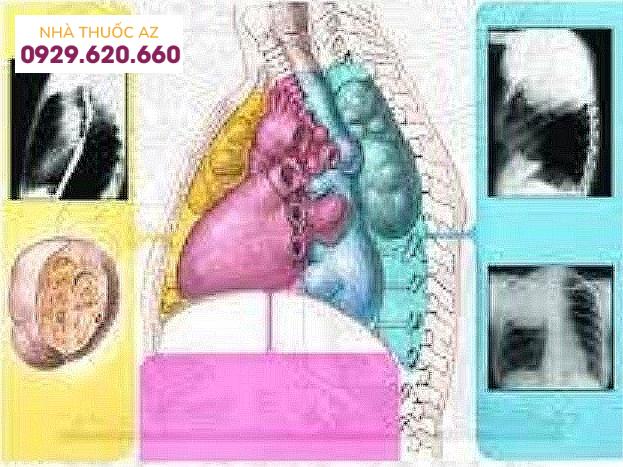 Hình ảnh minh họa nang thực quản đôi trong lồng ngực