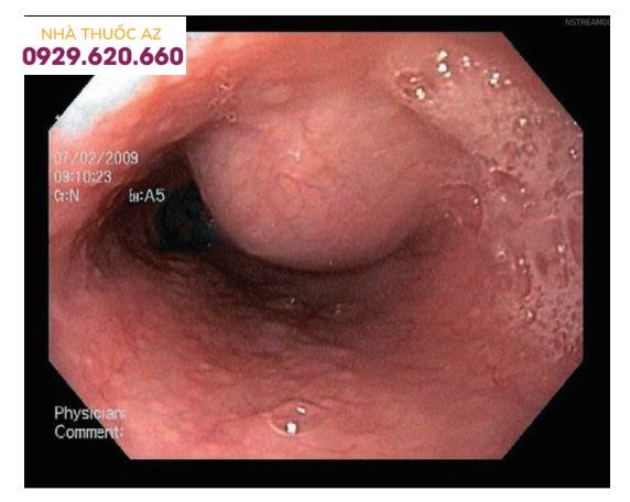 Hình ảnh nang thực quản đôi được nhìn thấy trên nội soi