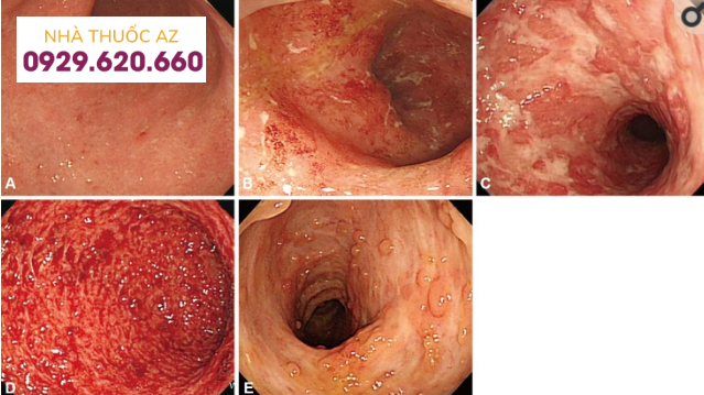 Nội soi điển hình của viêm loét đại tràng